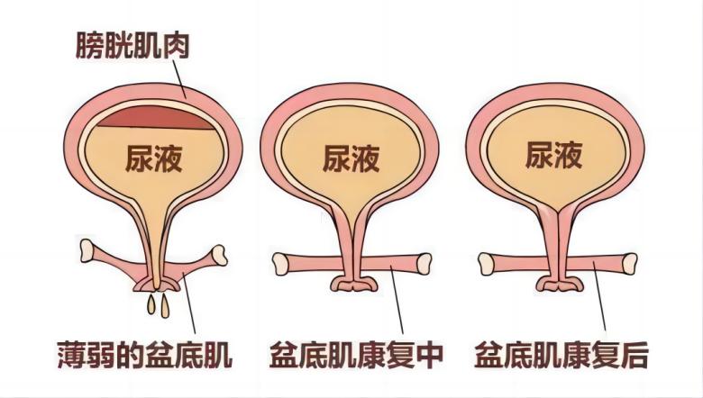 羽丰医疗丨如何有效运用振动提高盆底肌肉激活水平？